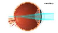 Illustration demonstrating  astigmatism