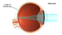 Illustration demonstrating  hyperopia