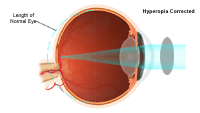 Illustration demonstrating  hyperopia corrected