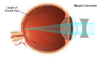Illustration demonstrating  myopia corrected