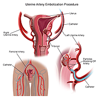 Illustration of an uterine artery embolization procedure