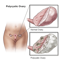 Illustration of a polycystic ovary