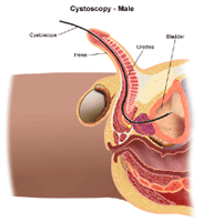 Illustration of cystoscopy