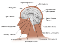 Illustration of the brain detailing common tumor sites, adult