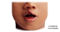 Illustration of  a unilateral incomplete cleft lip