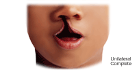 Illustration of  a unilateral complete cleft lip
