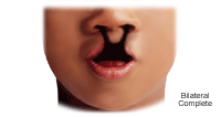 Illustration of  a bilateral complete cleft lip