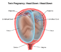 Illustration of a twin birth, head down/head down