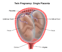 Illustration of a twin birth, head down/head down; 1 placenta, 2 cords