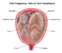 Illustration of a twin birth, twin to twin transfusion