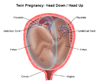 Illustration of a twin birth, head down/head up