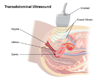 Illustration of a  transabdominal ultrasound procedure