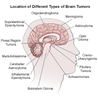 Illustration of  the brain detailing common tumor sites, adult