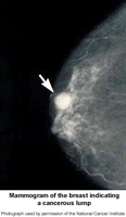 Picture of a mammogram of the breast indicating a cancerous lump