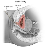 illustration of a female cystoscopy procedure