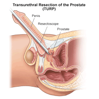 Illustration of Transurethral Resection of the Prostate (TURP)