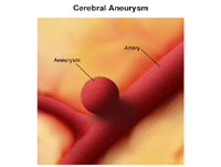 Illustration of cerebral aneurysm