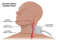 An illustration of a carotid duplex scan