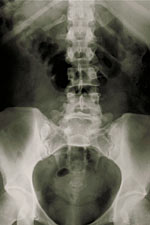 Photo of a Lumbar X-ray