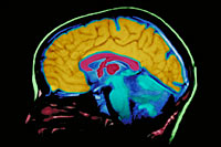 A  picture of a MRI brain scan film