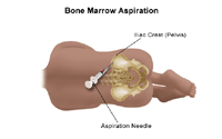 Illustration of a bone marrow aspiration procedure