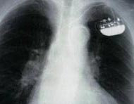 Picture of a chest X-ray, showing a single-chamber implanted pacemaker