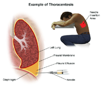 Illustration of a thoracentesis procedure