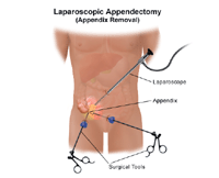 Illustration of laparoscopic appendectomy