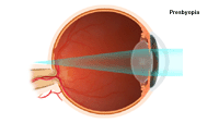 Illustration demonstrating  presbyopia