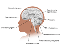 Illustration of the brain detailing common tumor sites, child