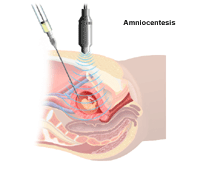 Illustration demonstrating an amniocentesis