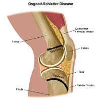 Illustration demonstrating Osgood-Schlatter disease