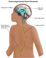 Illustration demonstrating ventriculoperitoneal shunt placement
