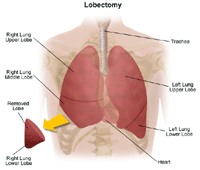 Illustration of a lobectomy procedure