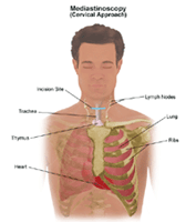 Illustration of a mediastinoscopy procedure