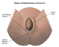 Illustration of an episiotomy procedure