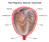 Illustration of a twin birth, head up/head down