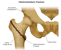 Illustration of Intertrochanteric Fracture