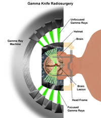 Gamma Knife Radiosurgery