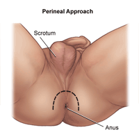 Illustration of perineal approach to prostatectomy