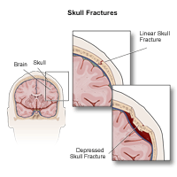 Illustration of different types of skull fractures