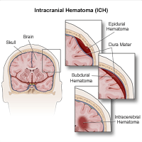 Illustration of Intracranial Hematoma