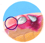 Illustration of first-degree burn