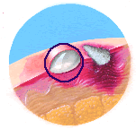Illustration of second-degree burn