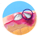 Illustration of third-degree burn