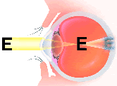 Illustration of eye: Nearsightedness