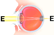Illustration of eye: Farsightedness
