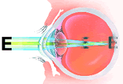 Illustration of eye: Astigmatism