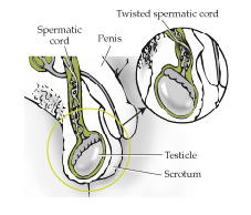 Illustration of testicular torsion
