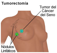 Ilustración de una lumpectomía 